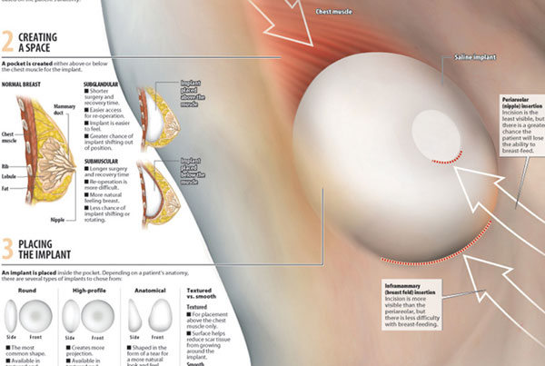 Sun Sentinel Breast Implants Infographic