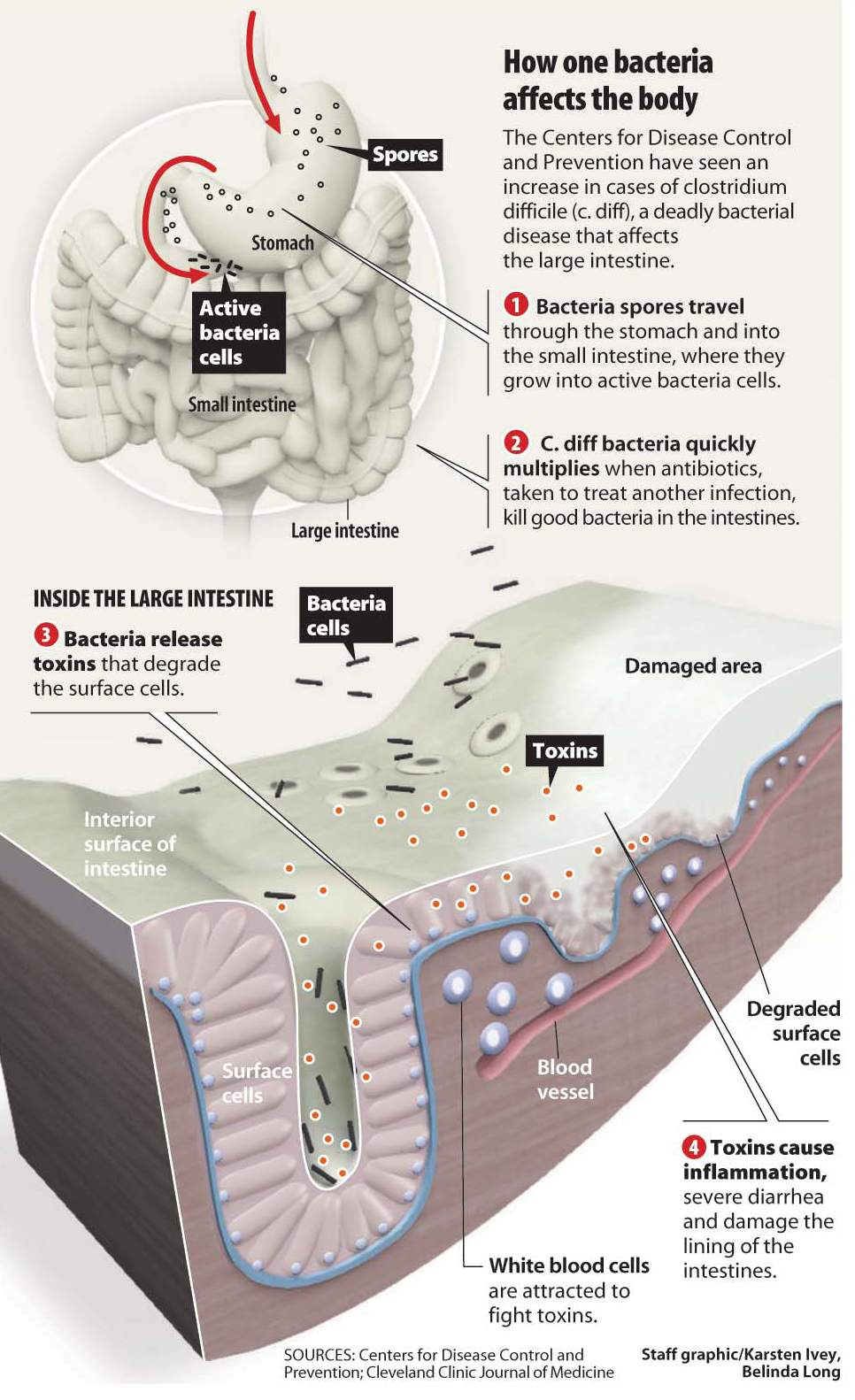 cdiff bacteria infographic