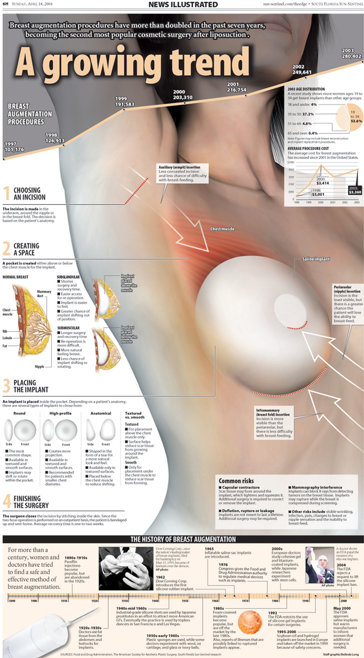 Breast Implants NI infographic