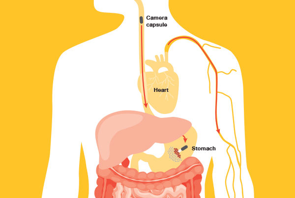 Stand Up To Cancer Detecting Gastric Cancer infographic