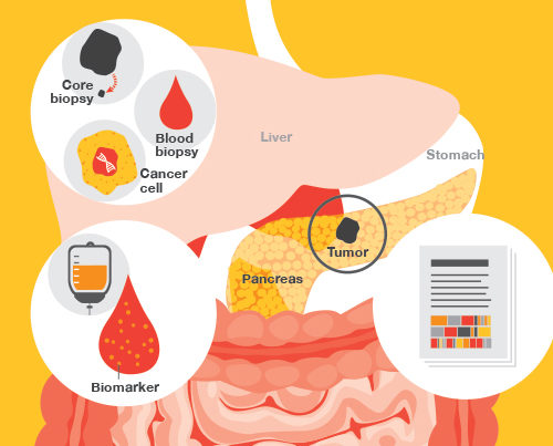 Pancreatic-cancer-Thumbs