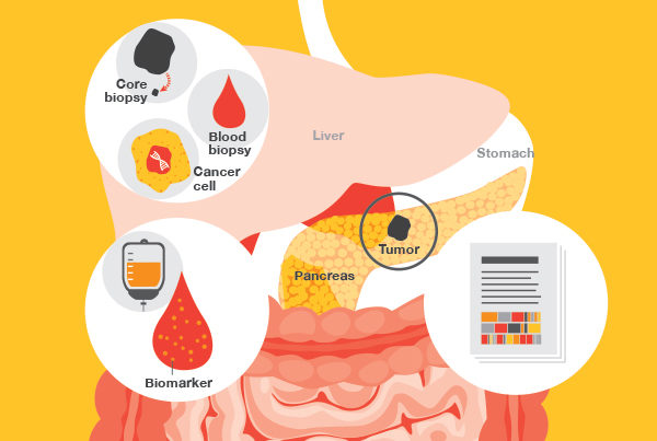 Stand Up To Cancer Pancreatic Cancer infographic